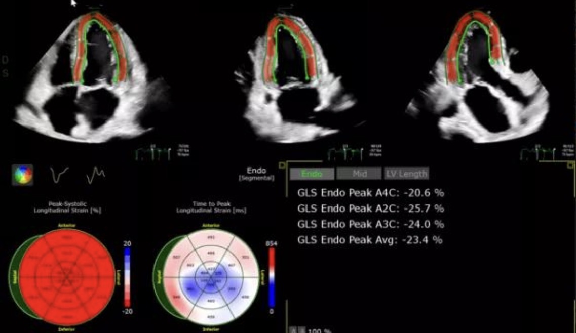 Imagem de strain miocárdico longitudinal em ecocardiograma pediátrico — Dra. Lúcia Moser, Recife